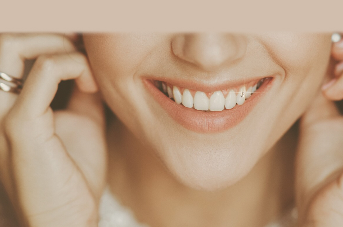 BIJOUX DENTAIRE - Soin professionnel chez BAASH Aesthetic à Langlade près de Nîmes