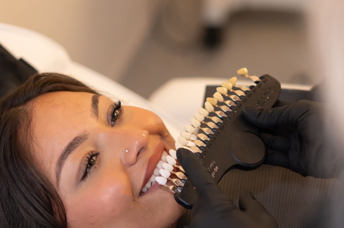 BLANCHIMENT DENTAIRE - Soin professionnel chez BAASH Aesthetic à Langlade près de Nîmes