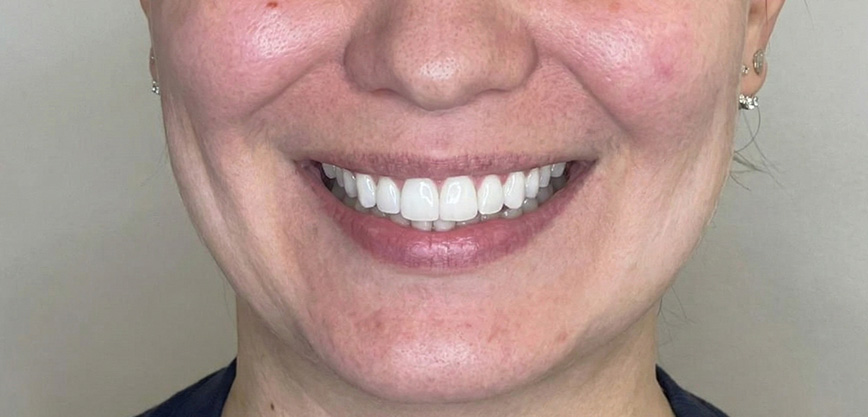 Après traitement - Soins Coréens KRX