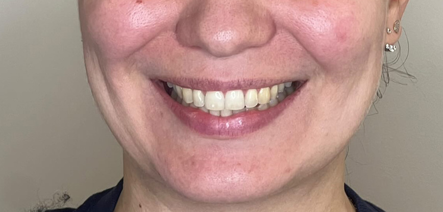 Avant traitement - Soins Coréens KRX